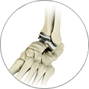 Ankle Joint Replacement